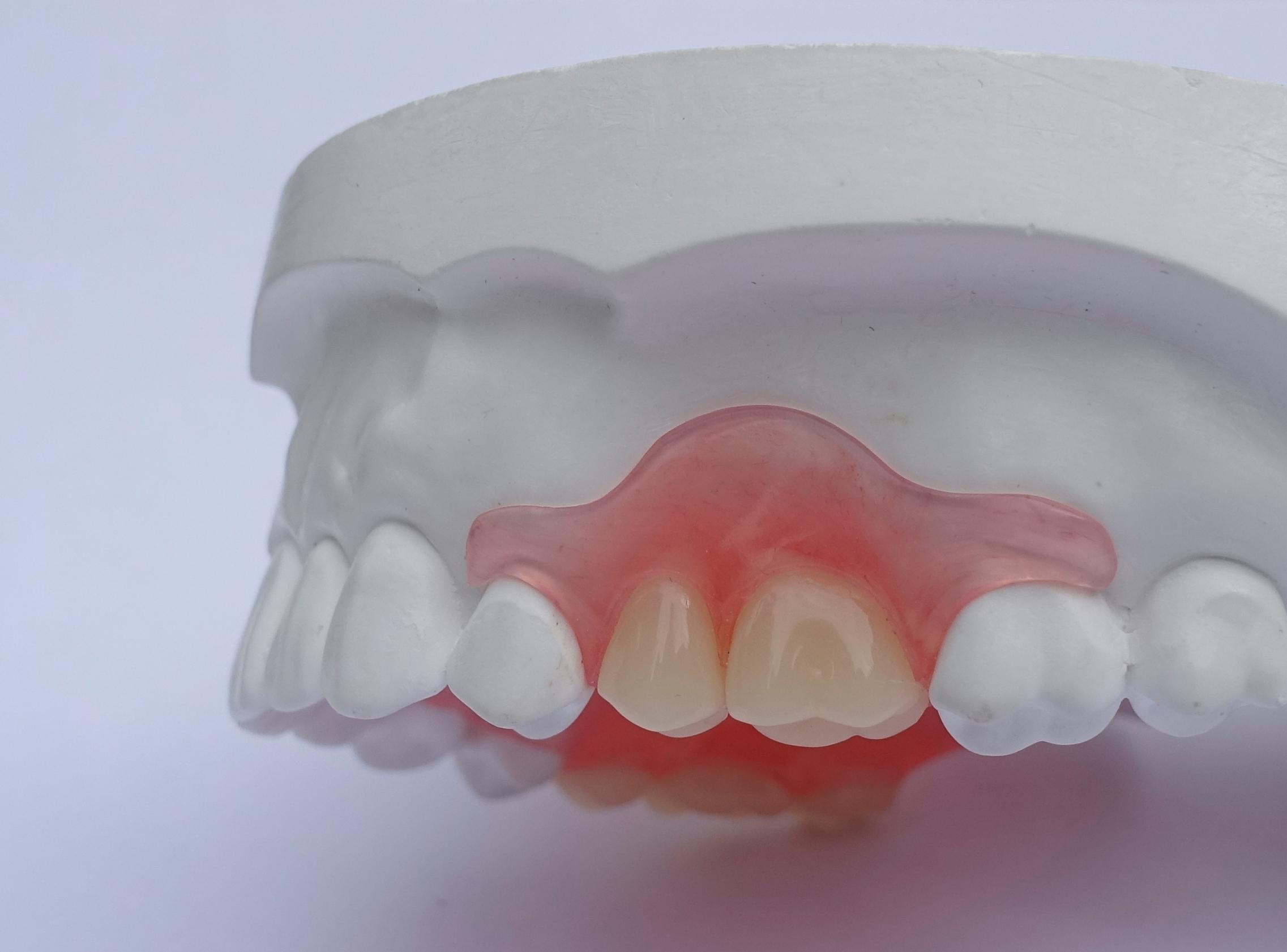 klei cruise Meetbaar Flexibele protheses - DentallXS