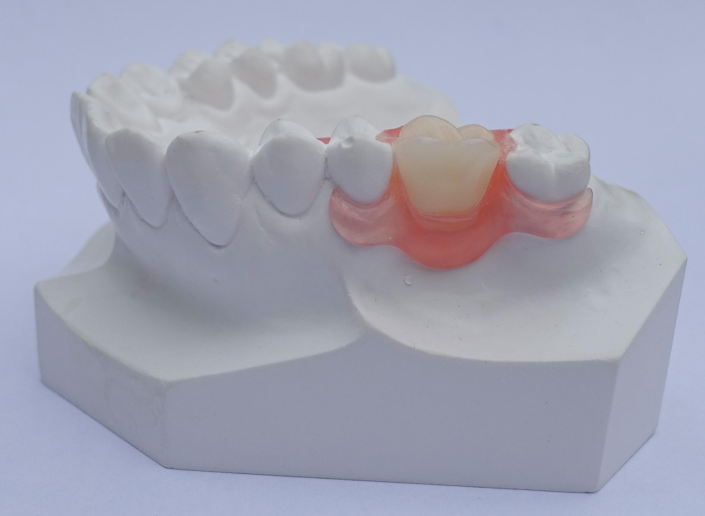 verliezen deadline Clancy Flexibele protheses - DentallXS