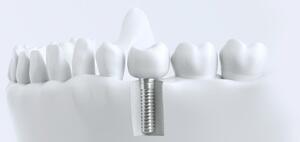 implantaten_1.jpg